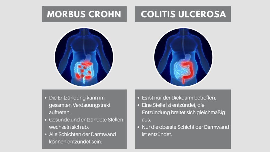 Abbildung der Krankheitsbilder von Morbus Crohn und Colitis ulcerosa.