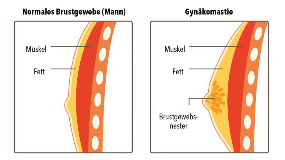 Der Aufbau eines normalen Brustgewebes wird dem Aufbau des Brustgewebes mit Gynäkomastie gegenübergestellt.