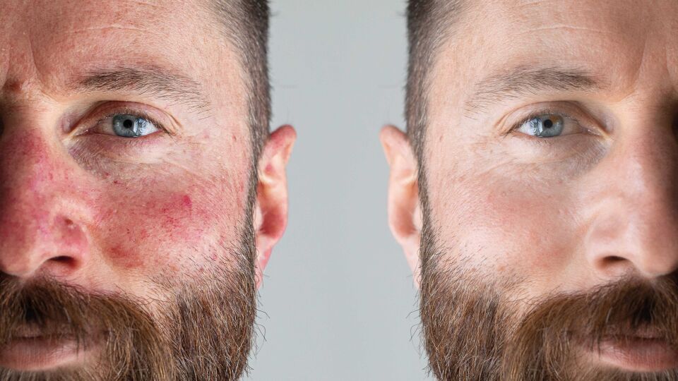gesichtshaut_shutterstock_2294206807 - Diabetes wirkt sich auf die Haut aus – im Gesicht kann eine Couperose auftreten –, aber vielen Hautproblemen kann mit einer täglich durchgeführten, gründlichen Pflegeroutine gut vorgebeugt werden.