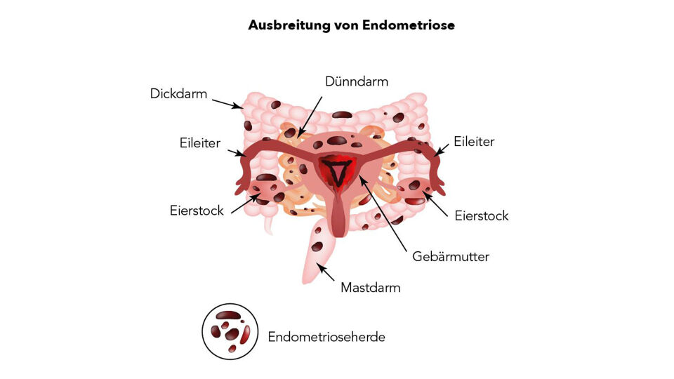 Ausbreitung von Endometriose deutsch - © Shutterstock/red