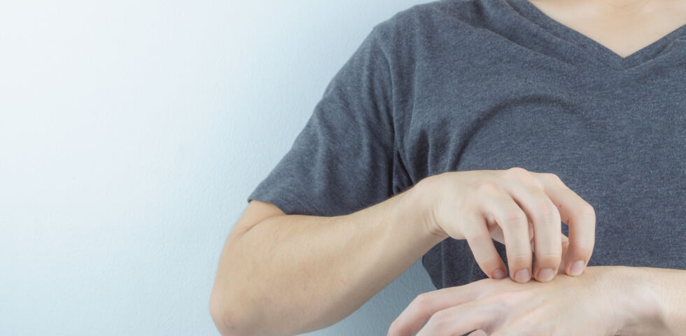Mann kratzt seine Hand Juckreiz Ekzem - Besonders an den Händen sind Ekzeme sehr unangenehm. - © Shutterstock