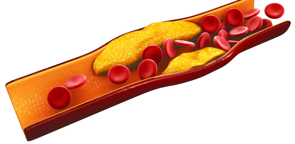 Triglyceride Laborwerte - Die Triglycerid-Werte werden durch eine Blutabnahme ermittelt. - © Shutterstock