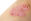 Psoriasis Hautkrankheit - Etwa 85 Prozent aller Betroffenen leiden an Psoriasis vulgaris, welche vorwiegend an den Außenseiten der Ellbogen- und Kniegelenke sowie im Bereich des Kopfes oder der Nägel auftritt. - © Shutterstock