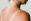 Sonnenbrand_shutterstock_1768670438 - Die typischen Anzeichen eines Sonnenbrands kennt jede/r: schmerzhafte Hautrötungen, spannende und berührungsempfindliche Haut, Brennen, Juckreiz, Hitzegefühl.  - © Shutterstock