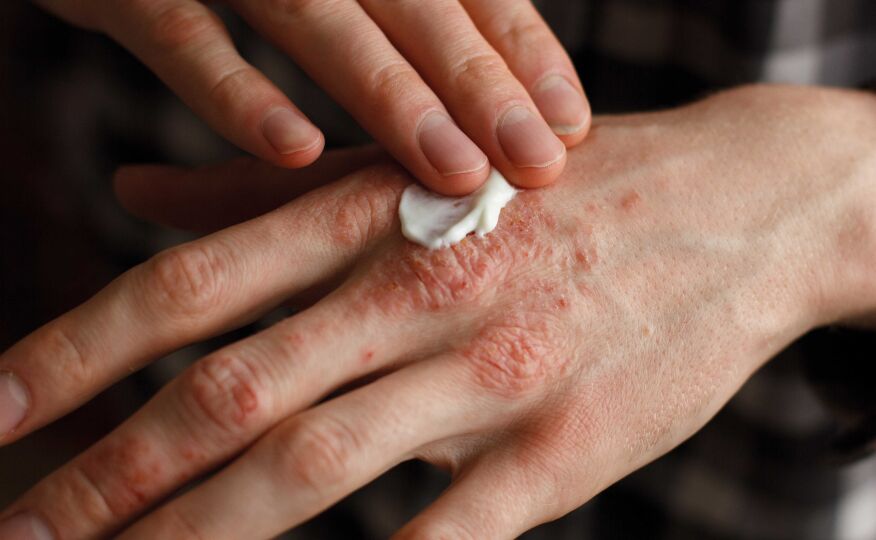 haut_shutterstock_551219668 - Egal, ob Sommer oder Winter: Die Basistherapie der Schuppenflechte ist und bleibt die tägliche Hautpflege, um die Hautbarriere zu stärken.