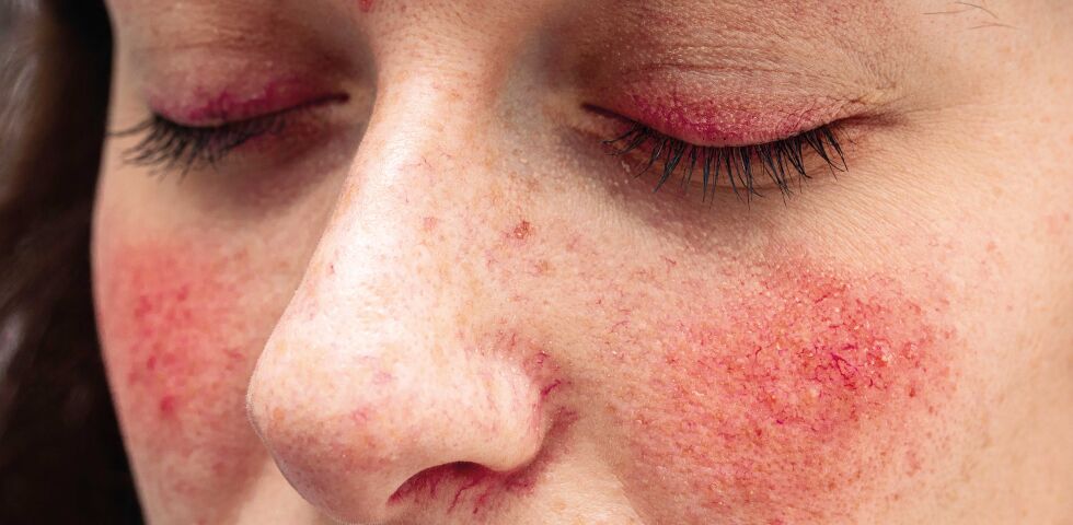 rosazea_shutterstock_1497569426 - Typisch für eine Rosazea ist, dass die Rötung der Haut im Bereich von Wangen, Kinn und Nase sowie später auch der Stirn dauerhaft bestehen bleibt.